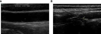 Performance Analysis of Machine Learning and Deep Learning Architectures on Early Stroke Detection Using Carotid Artery Ultrasound Images